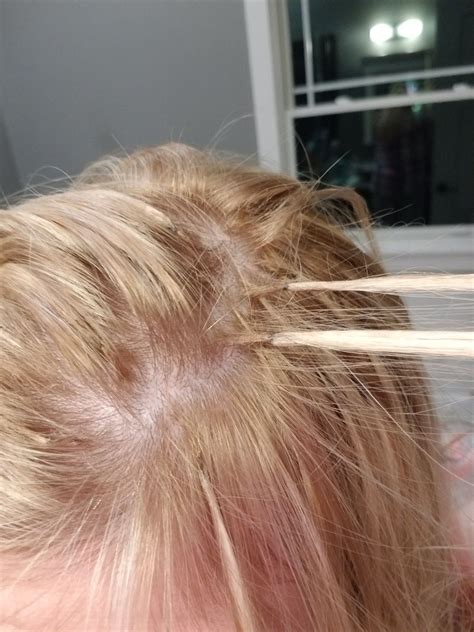 Do i have frontal fibrosing alopecia – Artofit