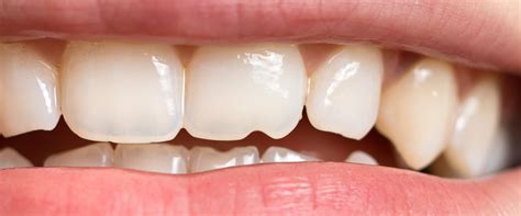 Broken or Severely Damaged Teeth: Causes and Treatment