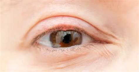 A Complete Guide to Bacterial Pink Eye Treatments