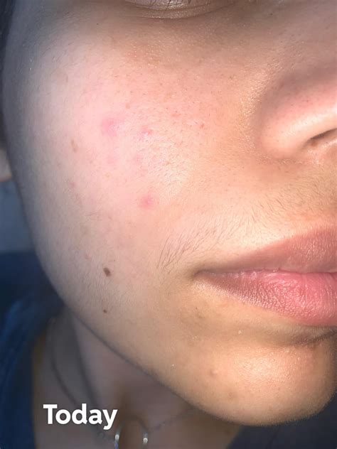 I get pustules from everything :( : r/Rosacea