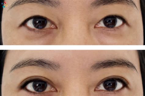 double eyelid surgery meaning benefits risks  procedure