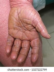 Keratoderma Photos, Images and Pictures