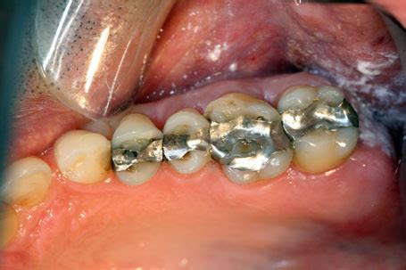 plombages dentaires invisibles  montreal centre dentaire masson