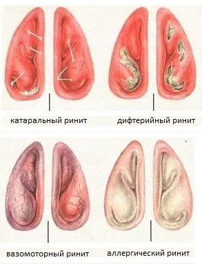 Вазомоторный ринит - симптомы, диагностика, лечение — медцентр Аксис ...