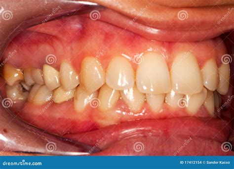 Human Teeth Royalty-Free Stock Image | CartoonDealer.com #17412154