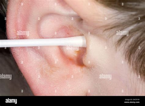 close   pus discharging   ear canal    year  male