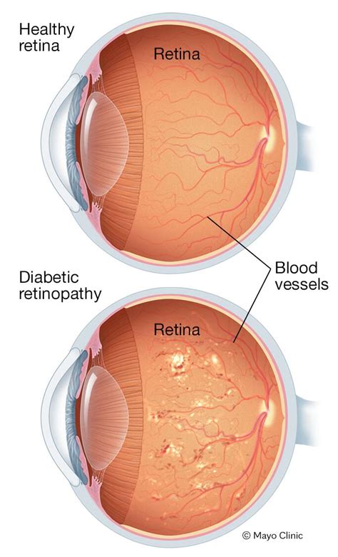 Retinopatía diabética - Síntomas y causas - Mayo Clinic