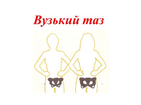 Вузький таз. Види вузьких тазів - презентация онлайн