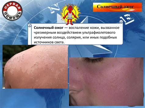 Солнечный ожог и солнечный (тепловой) удар. Первая помощь - презентация ...