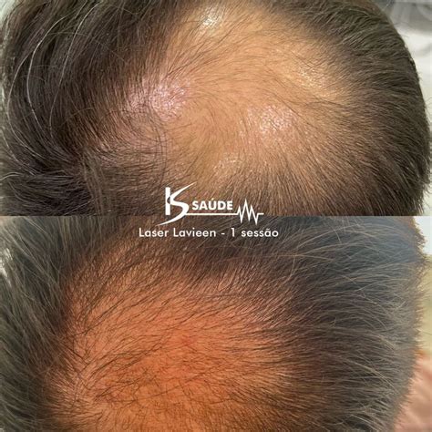 Laser Capilar Antes E Depois - Antes e depois: Laser Lavieen para tratamento capilar. | KS Saúde