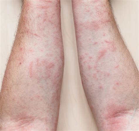 Psoriasis | North Idaho Dermatology