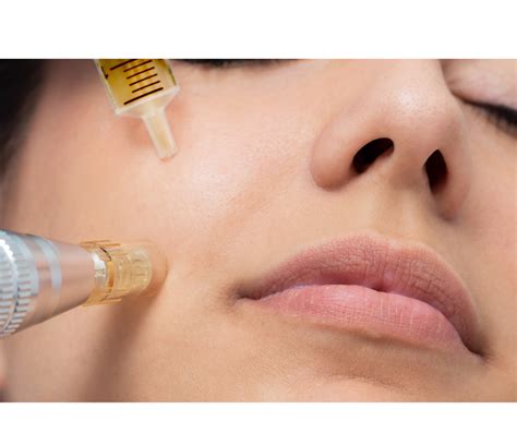 Micro needling - Tulip Dental