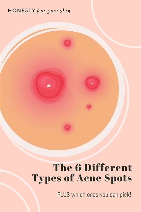 types  acne spots     pick