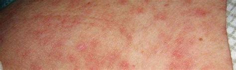 Skin Rash And Sexually Transmitted Diseases: Symptoms,, 43% OFF