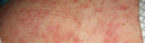 Skin Rash And Sexually Transmitted Diseases: Symptoms,, 43% OFF