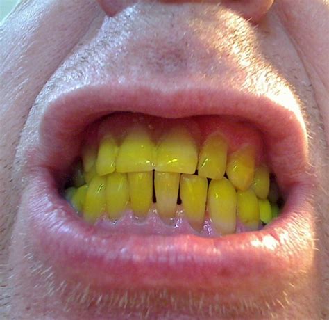 dientes muy amarillos los nuevos dientes de mi hijo son amarillos