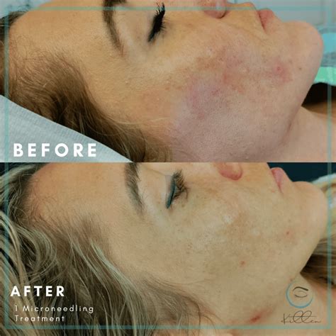 microneedling    lucie florida