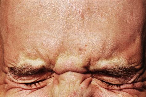 What Is Severe Spinal Stenosis?