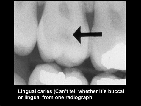 radiographic-caries-diagnosis