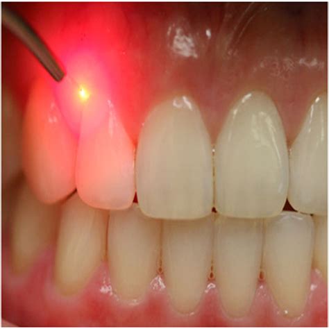 DellwoodDental.com.au | Laser Dentistry