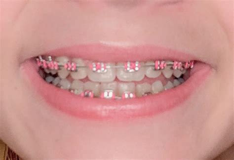 braces colors   light pink braces