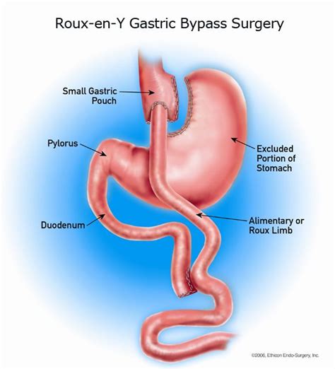 Roux-en-Y Gastric Bypass is what I had! | Gastric bypass, Bypass ...