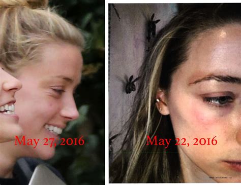 For the handful of people on my previous post saying the bruise on her