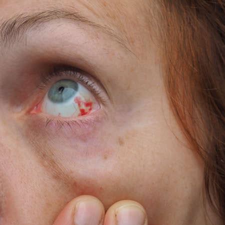 Photo of Subconjunctival hemorrhage or - ID:174771016 - Royalty Free ...