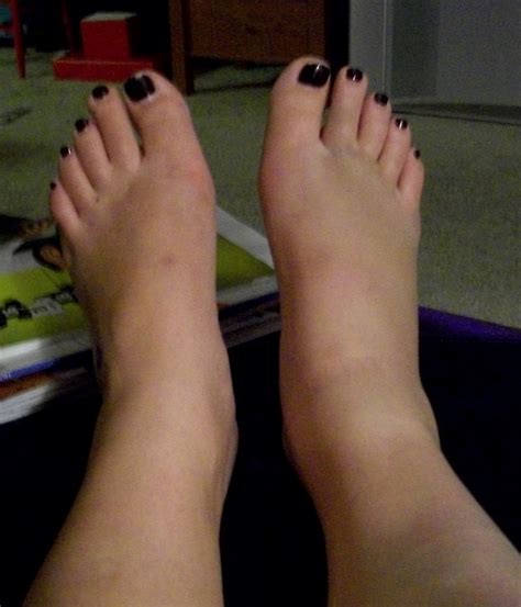 with a side of insulin: that time i hurt my ankle. and leg.
