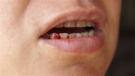 Gosto De Sangue Na Boca O Que Pode Ser - Gosto de sangue na boca: o que pode ser?