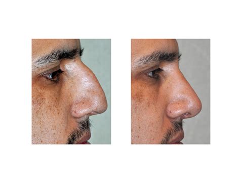 Case Study: The High Radix Rhinoplasty - Explore Plastic Surgery