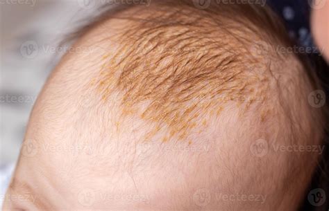 The process of formation of seborrheic dermatitis in an infant on the