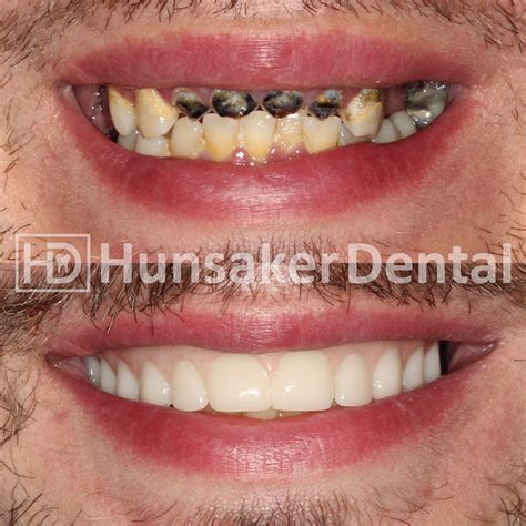 Full Mouth Dental Implants - Hunsaker Dental - Salem and Monmouth