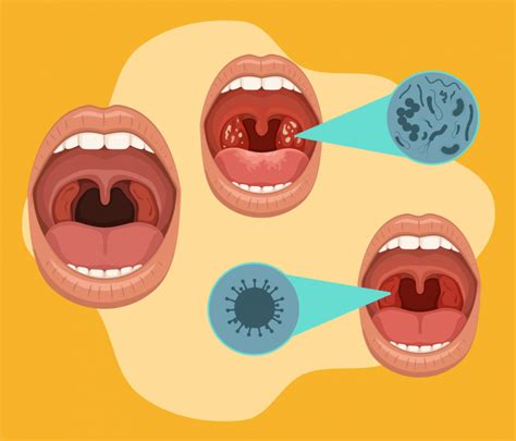 Amigdalite Bacteriana Como Tratar - Amigdalite Bacteriana: Como Tratar – VWJHZ
