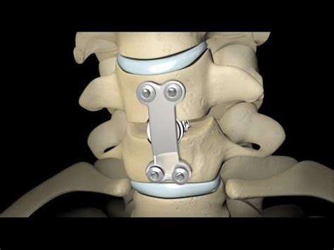 What is Spinal Fusion? | Medtalk