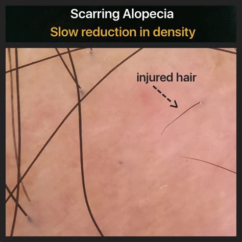 Injured hairs in Lichen planopilaris (LPP) — Donovan Hair Clinic