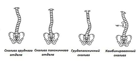 Типы сколиотического искривления позвоночника по локализации
