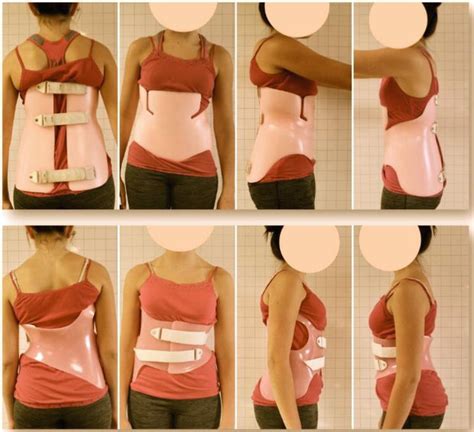 brace treatment  children  adolescents  scoliosis intechopen