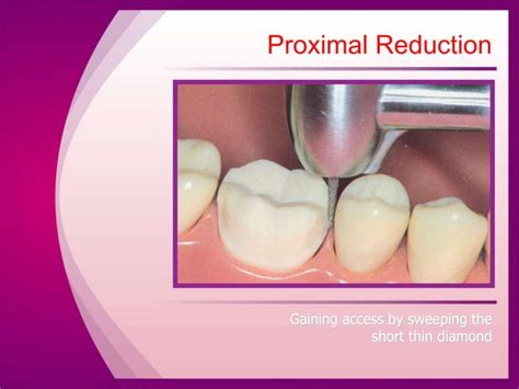 full veneer tooth preparation principals and steps | PPTX