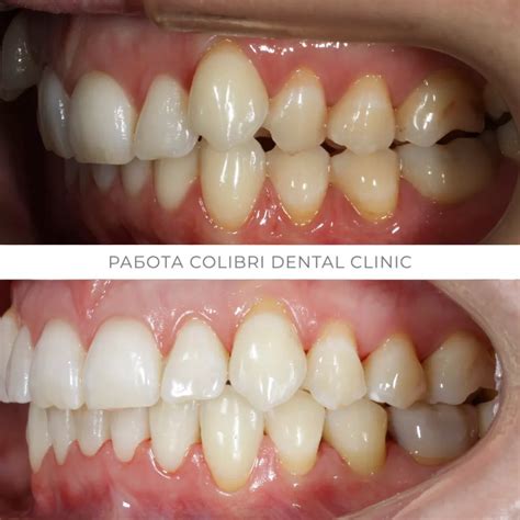 Коррекция дистального прикуса в стоматологии Colibri Dental