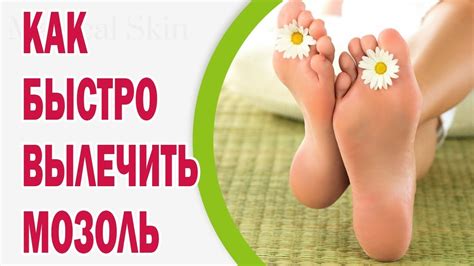 Как быстро вылечить мозоль - YouTube