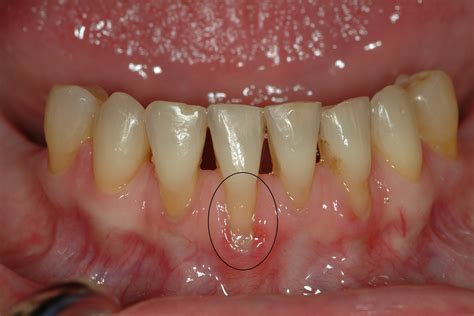 how to reverse gum recession 7
