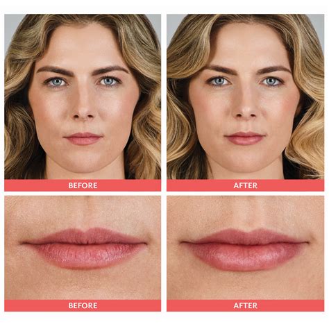 Dermal Fillers | Feel Ideal 360 Med Spa | Southlake, TX