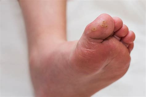 How to Treat Plantar Warts - Revolution Style – Revolution Health