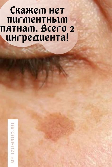 Скажем нет пигментным пятнам. Всего 2 ингредиента! | Fitness body, Skin ...