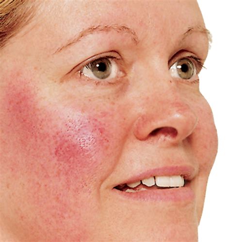 Rosacea