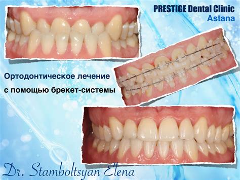 Сапфировые брекеты - Портфолио