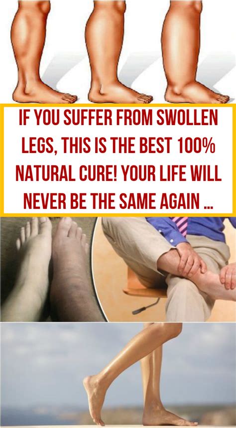 If You Suffer From Swollen Legs, This Is The Best 100% Natural Cure! Your Life Will Never Be The ...