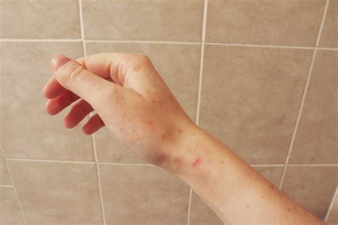 The 14 Best Eczema Creams, Tested by Real People with Eczema