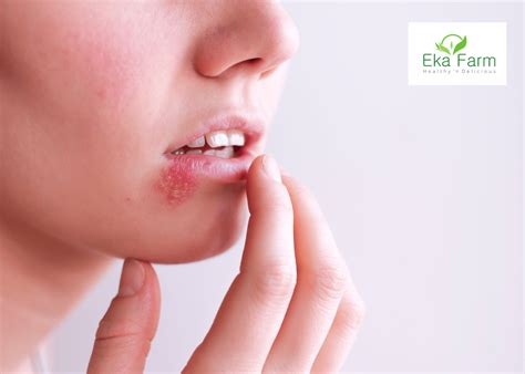 herpes gejala penyebab   mengobatinya